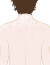 Jak se vyhnout akné na krku