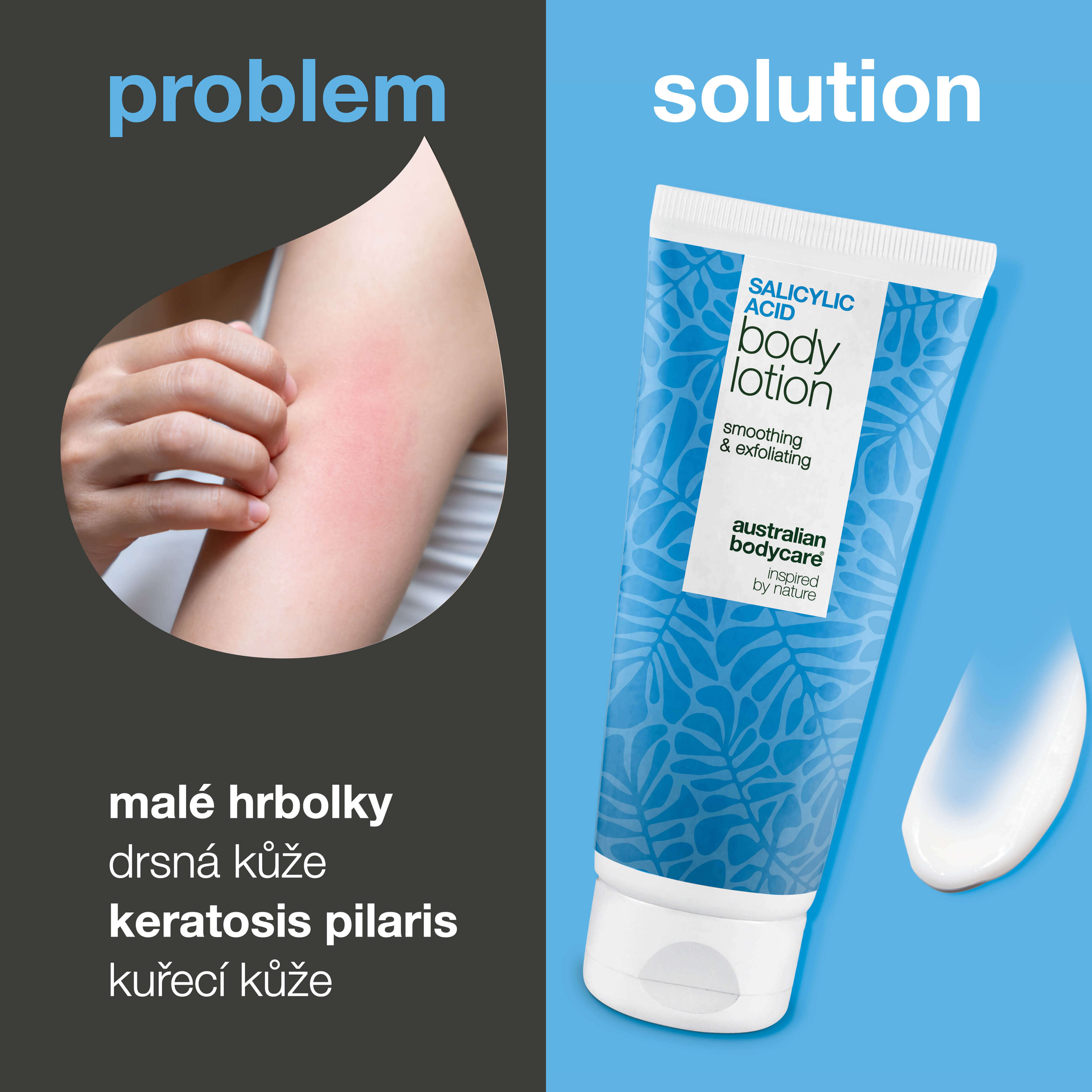 Tělové mléko na keratosis pilaris zjemňuje drsnou pokožku a redukuje pupínky. Obsahuje kyselinu salicylovou, niacinamid a zinek PCA.