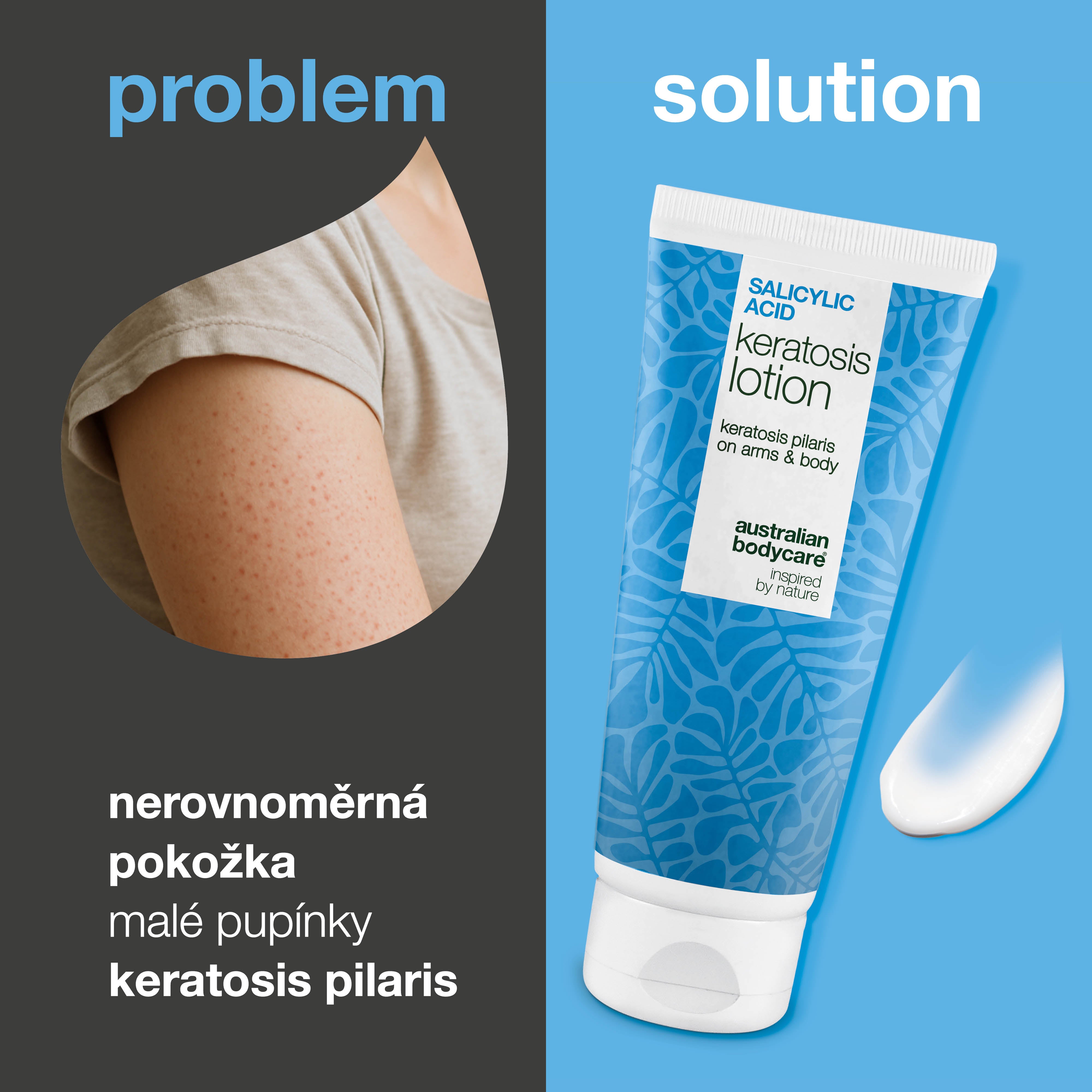 Tělové mléko na keratosis pilaris a hrubou pokožku — Tělové mléko na keratosis pilaris. Zjemňuje pokožku díky kyselina salicylová, niacinamidu a zinku.