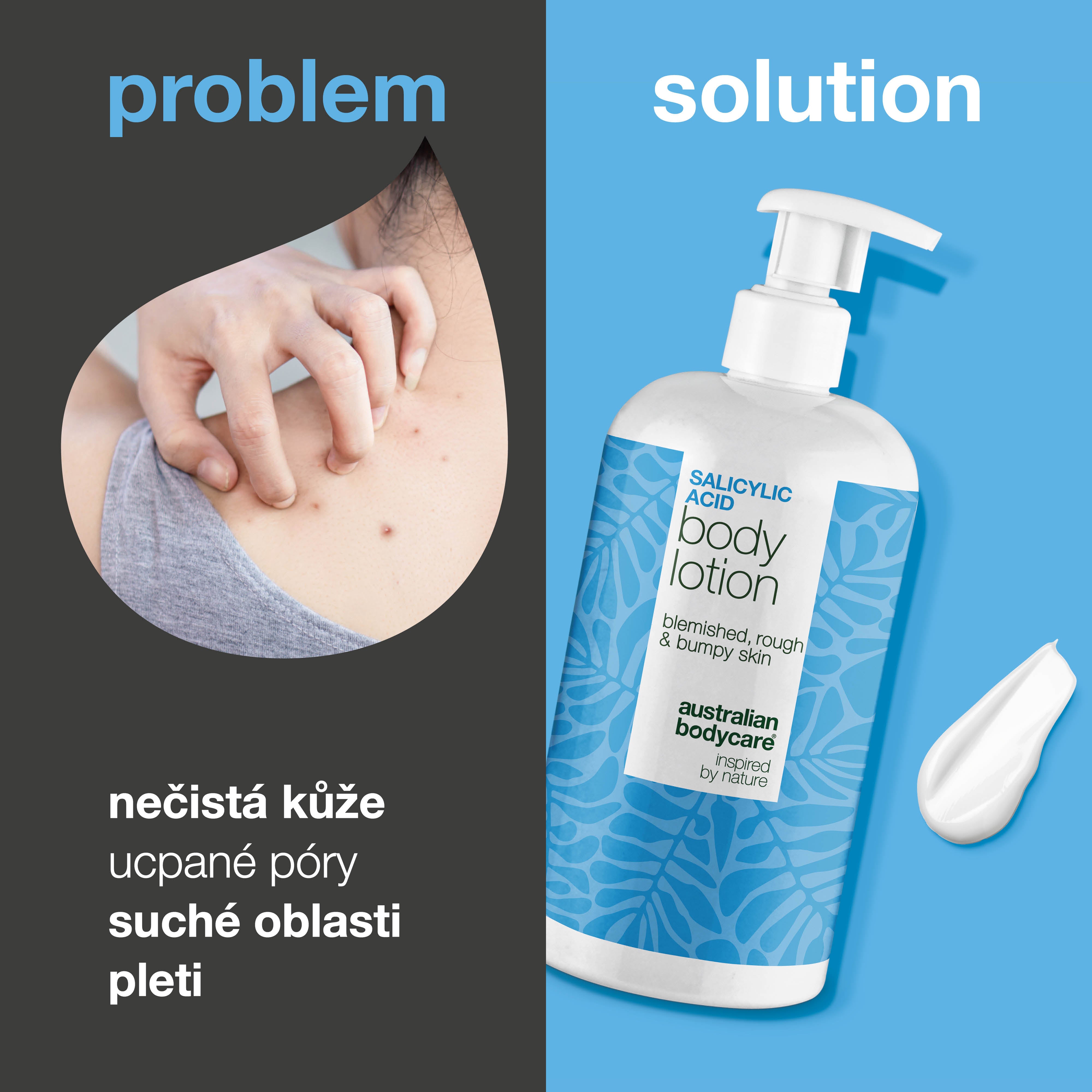 Tělové mléko s kyselina salicylová – suchá a hrubá pokožka — Tělové mléko s kyselina salicylová jemně exfoliuje, hydratuje a pomáhá vyhladit suchou a hrubou pokožku. Ideální pro každodenní péči.