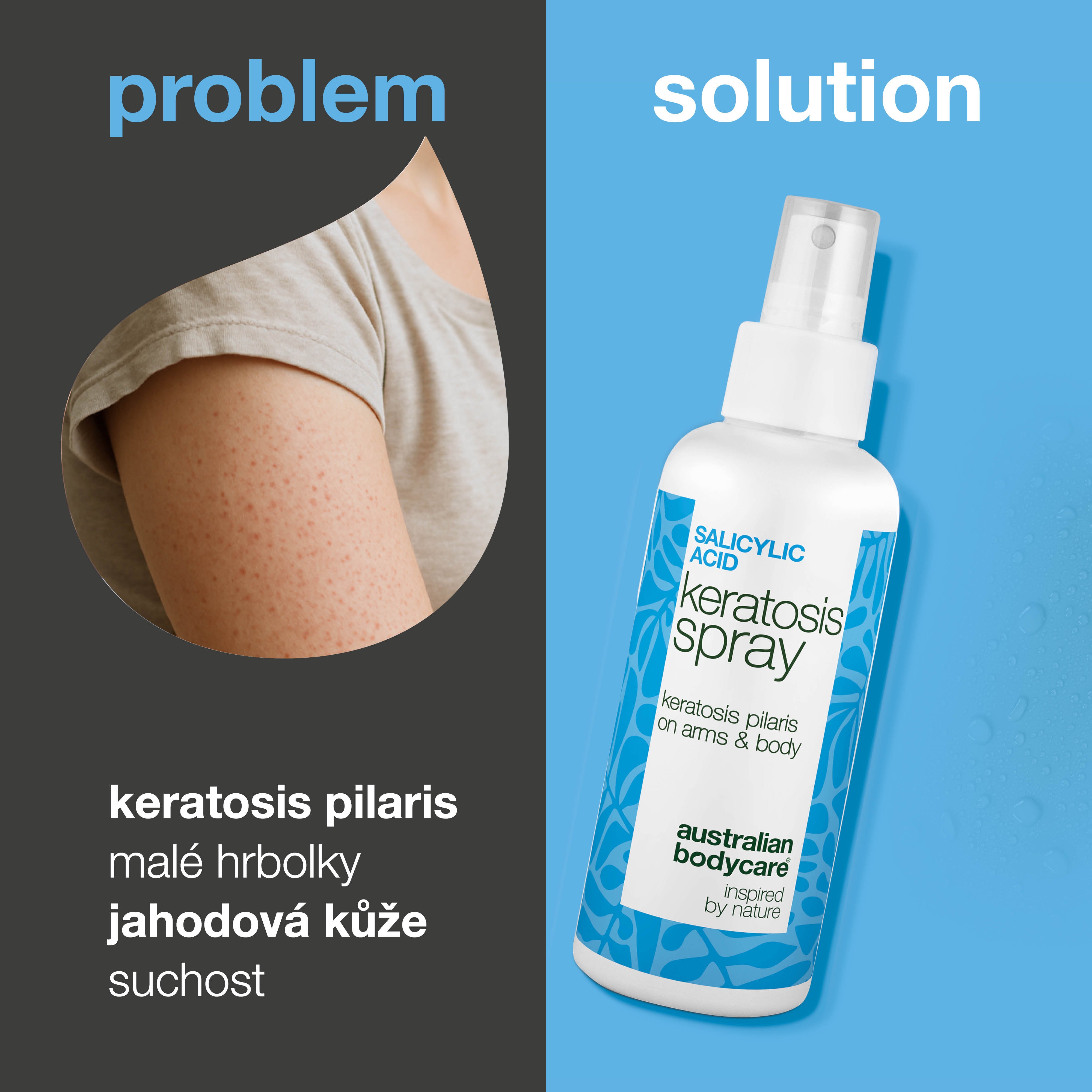 Sprej na keratosis pilaris a hrubou pokožku s pupínky — Keratosis pilaris sprej zmírňuje hrbolky a drsnou kůži. Obsahuje kyselinu salicylovou pro jemné čištění a vyhlazení.