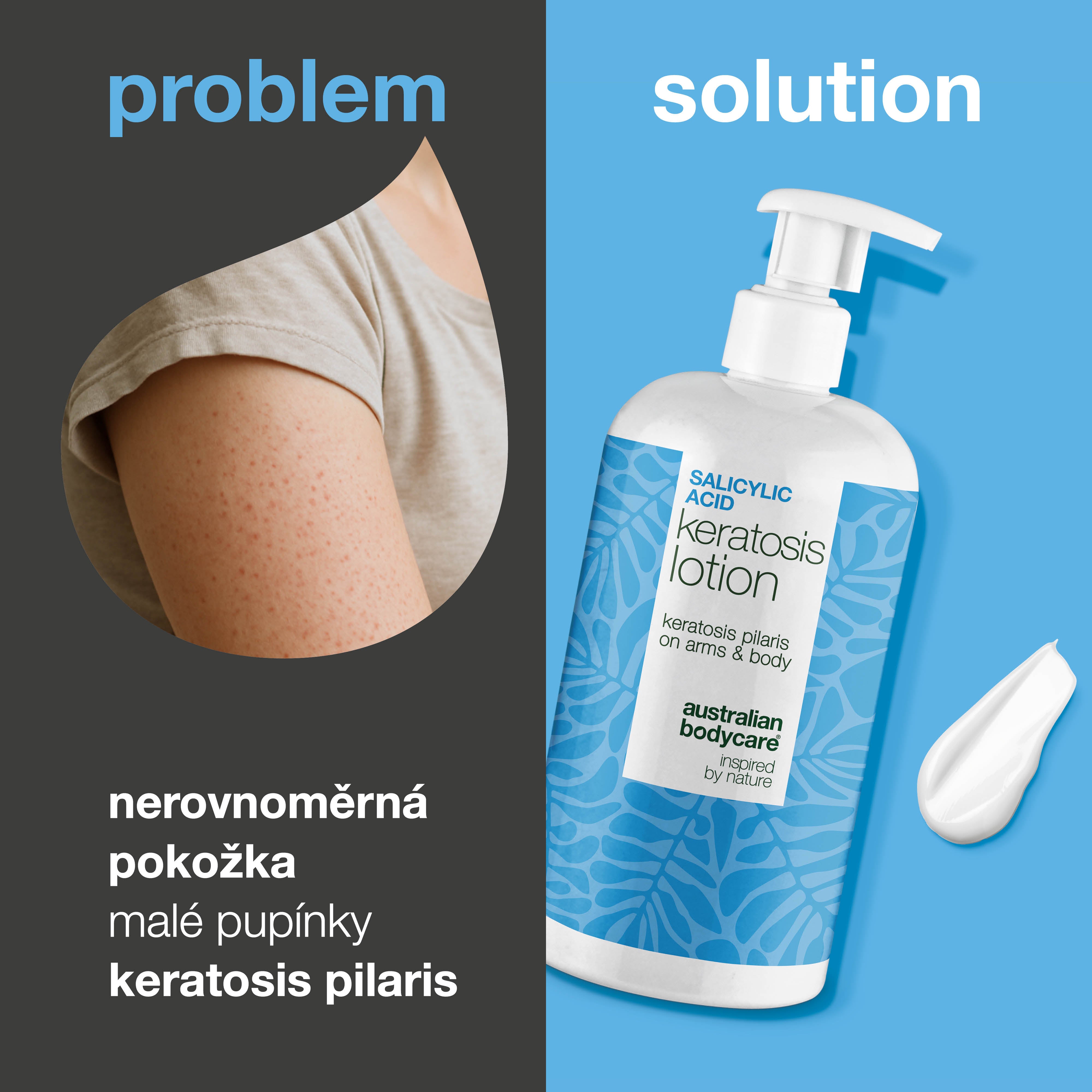 Tělové mléko na keratosis pilaris a hrubou pokožku — Tělové mléko na keratosis pilaris. Zjemňuje pokožku díky kyselina salicylová, niacinamidu a zinku.