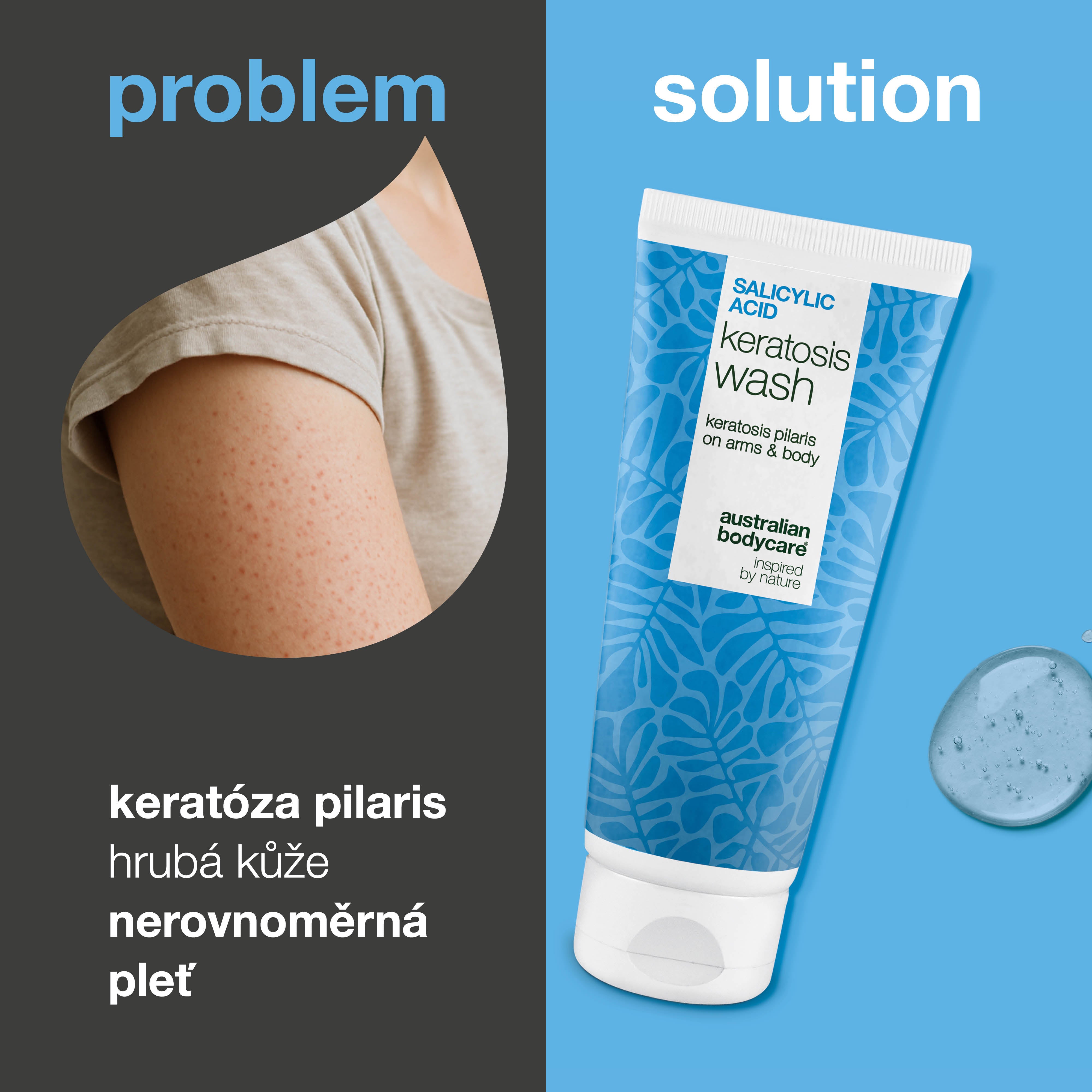 Keratosis Pilaris Sprchový gel na keratózu pilaris, ucpané póry a zarudnutí. S kyselinou salicylovou, niacinamidem, zinkem PCA a vitamínem E pro viditelné výsledky.