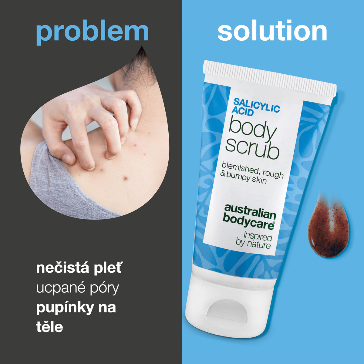 Problém a řešení: pupínky na těle, ucpané póry a nerovná pokožka. Vlevo detail ramene s pupínky, vpravo Salicylic Acid Body Scrub od Australian Bodycare