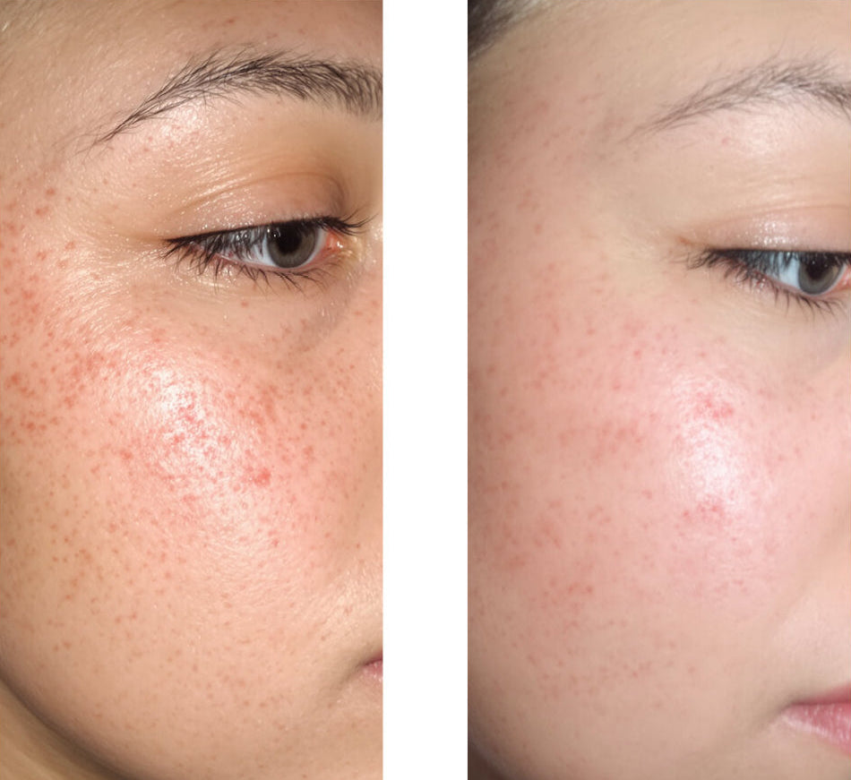 Fotografie před a po zákazníka používajícího naše 2% Salicylic Acid Face Serum, ukazující velké zlepšení pleti s méně pupínky a nedokonalostmi.