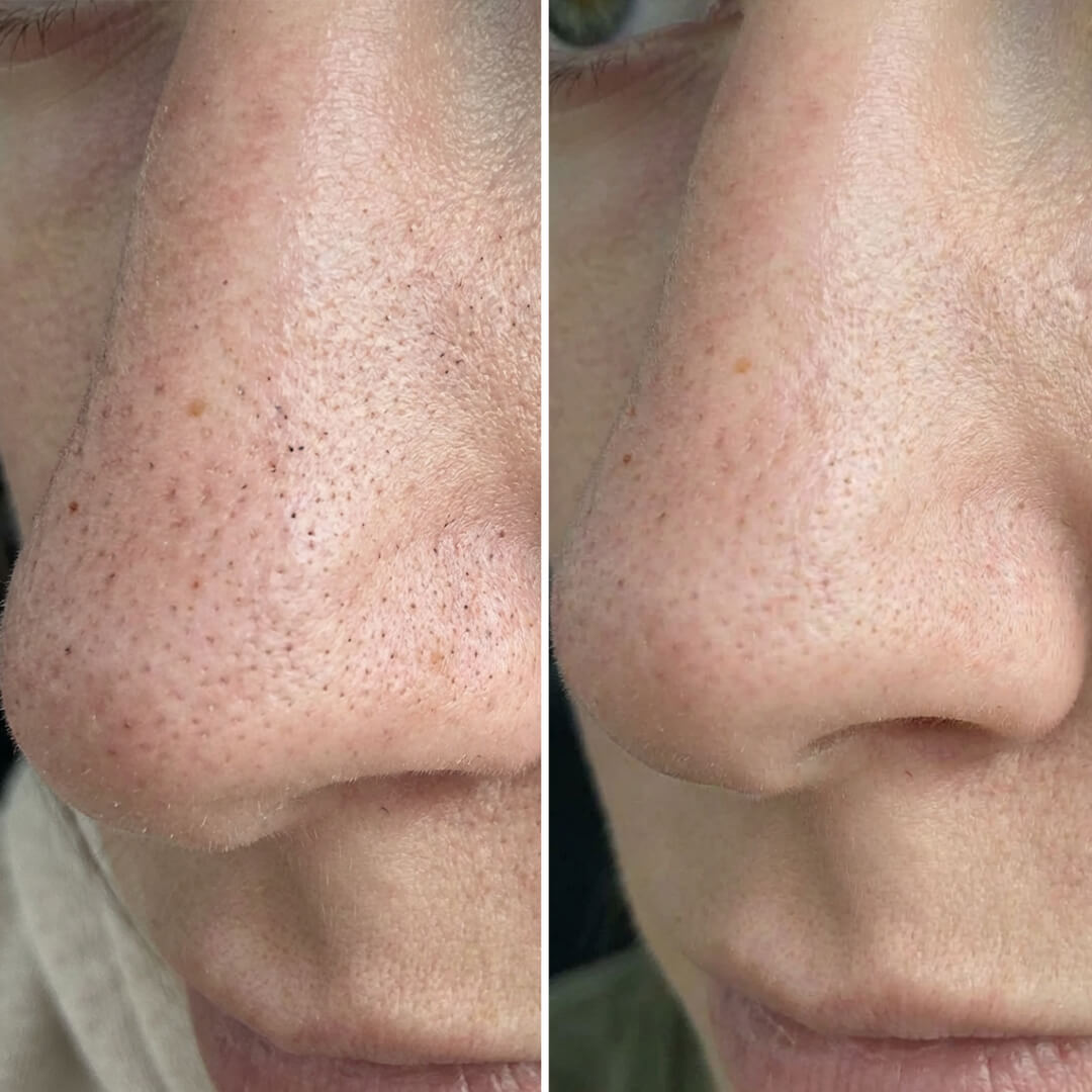 Sada proti černým tečkám a ucpaným pórům s kyselinou salicylovou – hloubkové čištění pro hladkou pleť