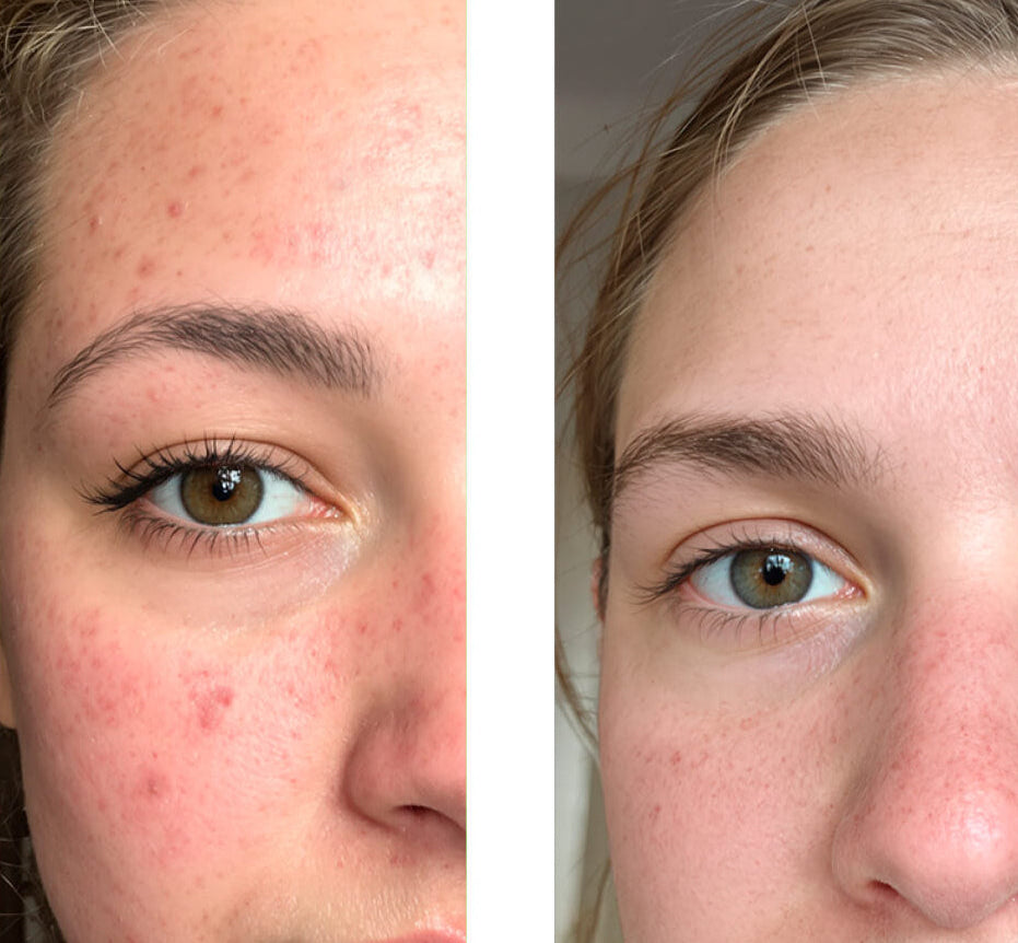 Fotografie před a po zákazníka používajícího naše 2% Salicylic Acid Face Toner/Peeling/Exfoliant, ukazující velké zlepšení pleti s méně pupínky a nedokonalostmi.