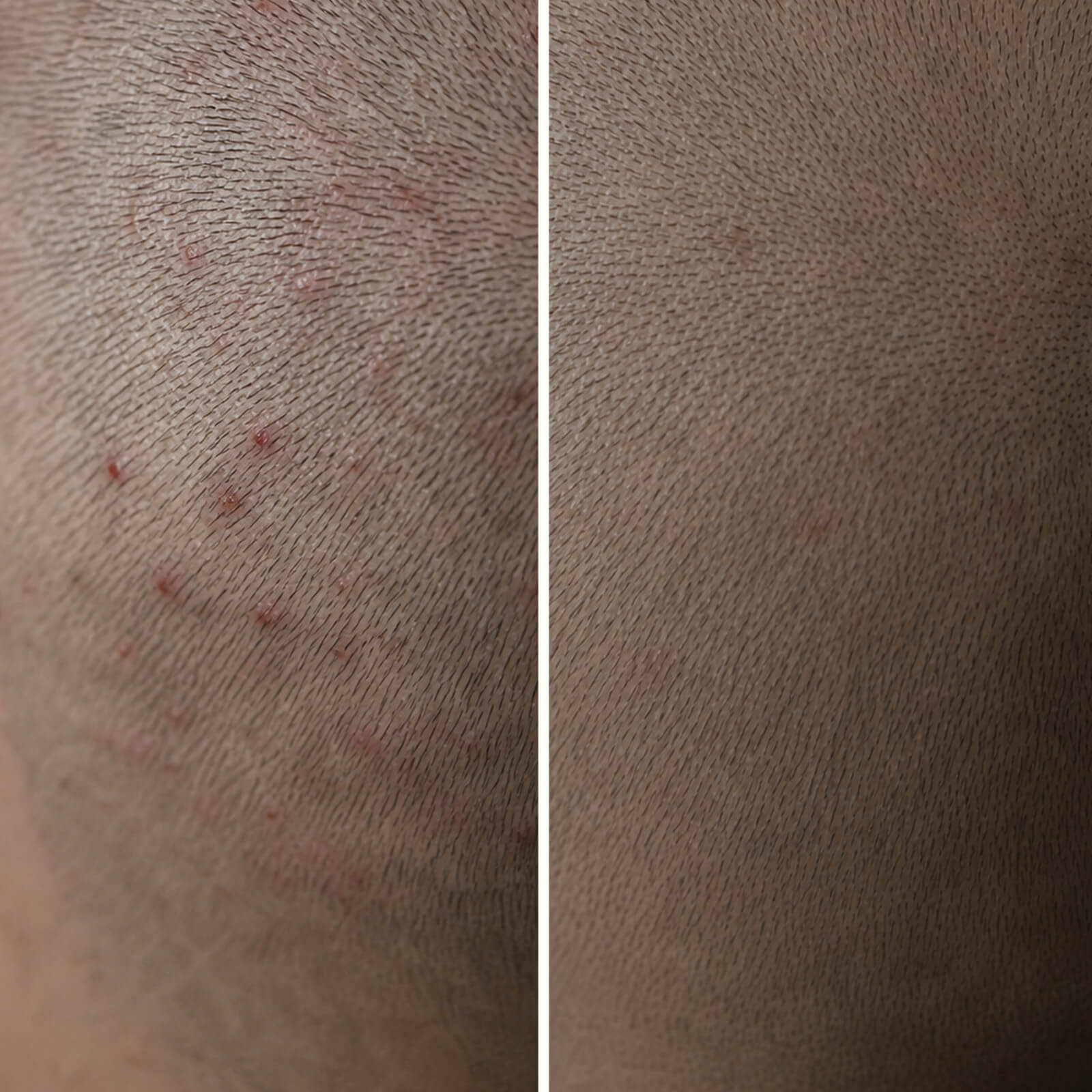 Gel s kyselinou salicylovou na pupínky a svědění hlavy — Zastavte pupínky v pokožce hlavy! Kyselina salicylová čistí póry, redukuje mastnotu a okamžitě zklidňuje zarudlá a bolavá místa.