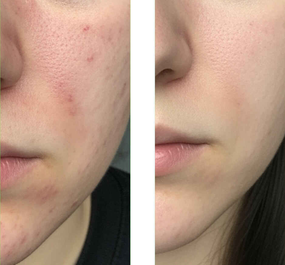 Fotografie před a po zákazníka používajícího náš Salicylic Acid Cleanser, ukazující velké zlepšení pleti s méně pupínky a nedokonalostmi.