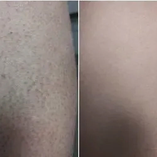 Výsledek Aleny po 2 týdnech s léčebnou sadou keratosis pilaris