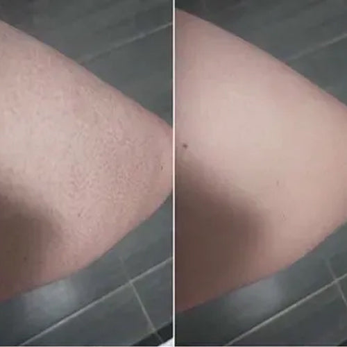 Keratosis pilaris před a po – hladší pokožka Aleny po 2 týdnech