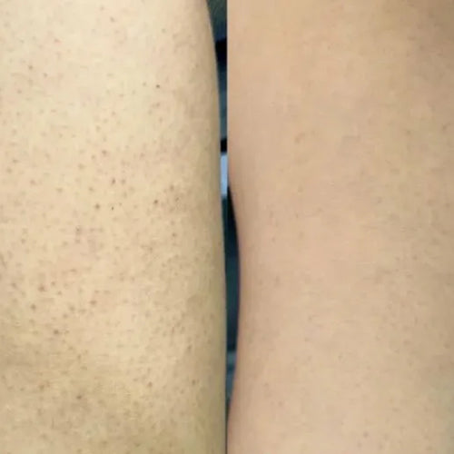Výsledek Isabell s léčebnou sadou keratosis pilaris – méně pupínků na stehnech