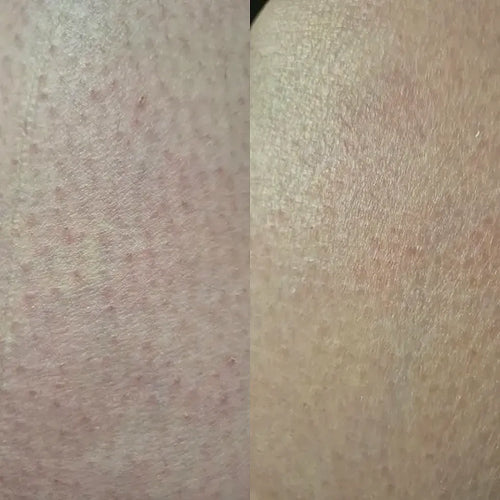 Detail pokožky po léčbě keratosis pilaris – výsledek Carolin