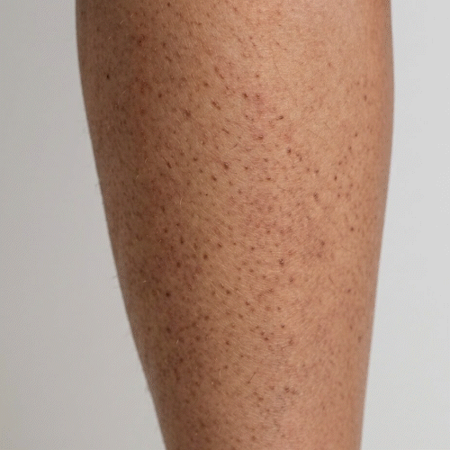 Detail keratosis pilaris – drobné drsné pupínky na pažích