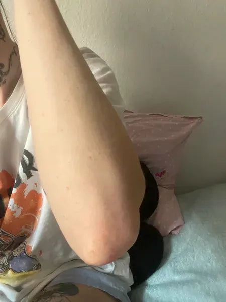 Výsledek zákazníka keratosis pilaris – Lisa A.