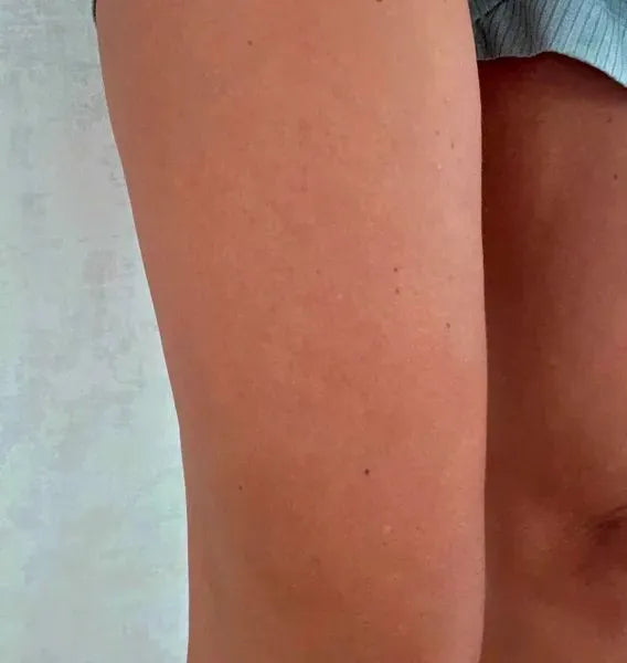 Výsledek zákazníka keratosis pilaris – Sarah S.
