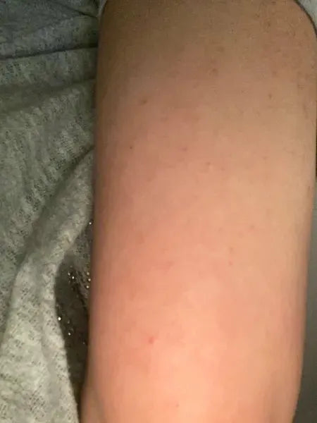 Výsledek zákazníka keratosis pilaris – Shaian H. používá Australian Bodycare