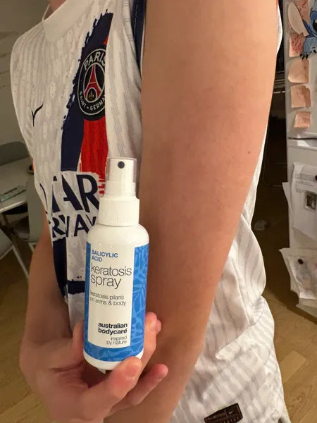 Výsledek zákazníka keratosis pilaris – 70% méně pupínků po 3 týdnech